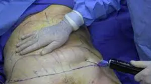Advanced & Affordable Liposuction Surgery